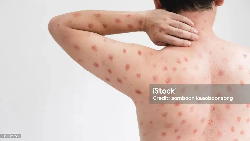 Pemerintah didesak sigap melakukan upaya pencegahan dan pengendalian penyakit cacar monyet atau monkeypox (Mpox) di DKI Jakarta. foto: iStock