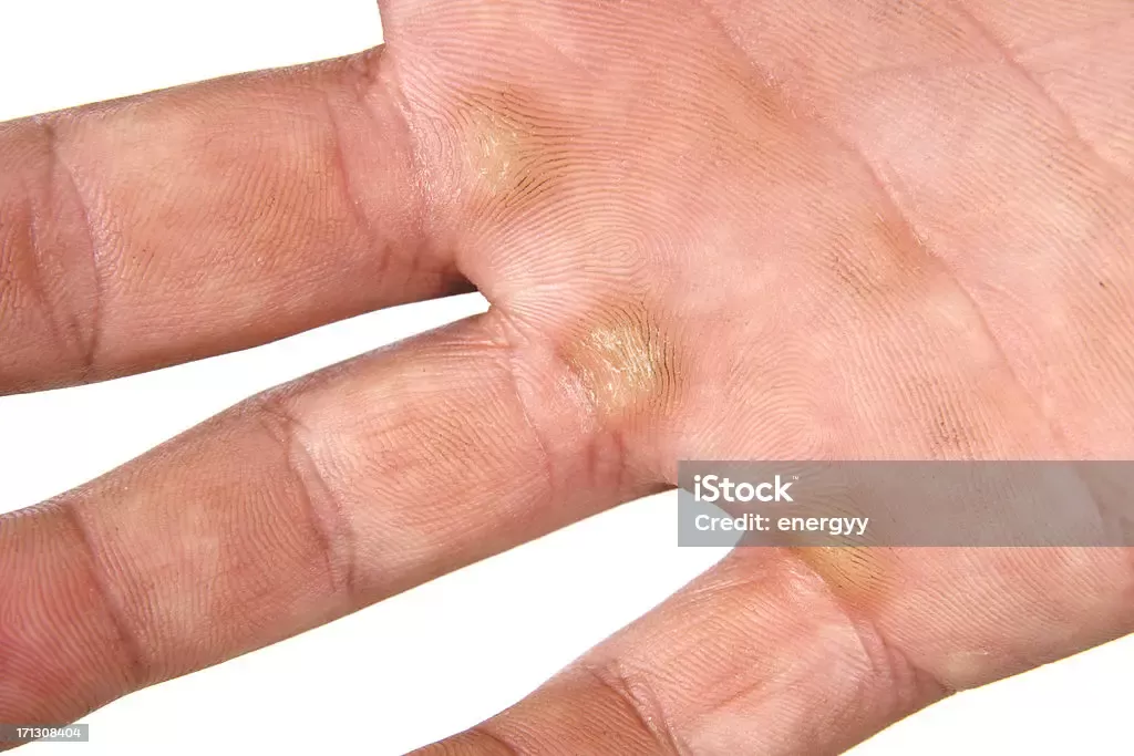 Kapalan atau callus, merupakan suatu kondisi yang ditandai dengan adanya lapisan tebal dan keras pada kulit. foto: iStock