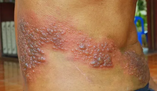 Herpes, penyebab, gejala dan pengobatan penyakit yang disebabkan oleh infeksi virus ini. foto: ist