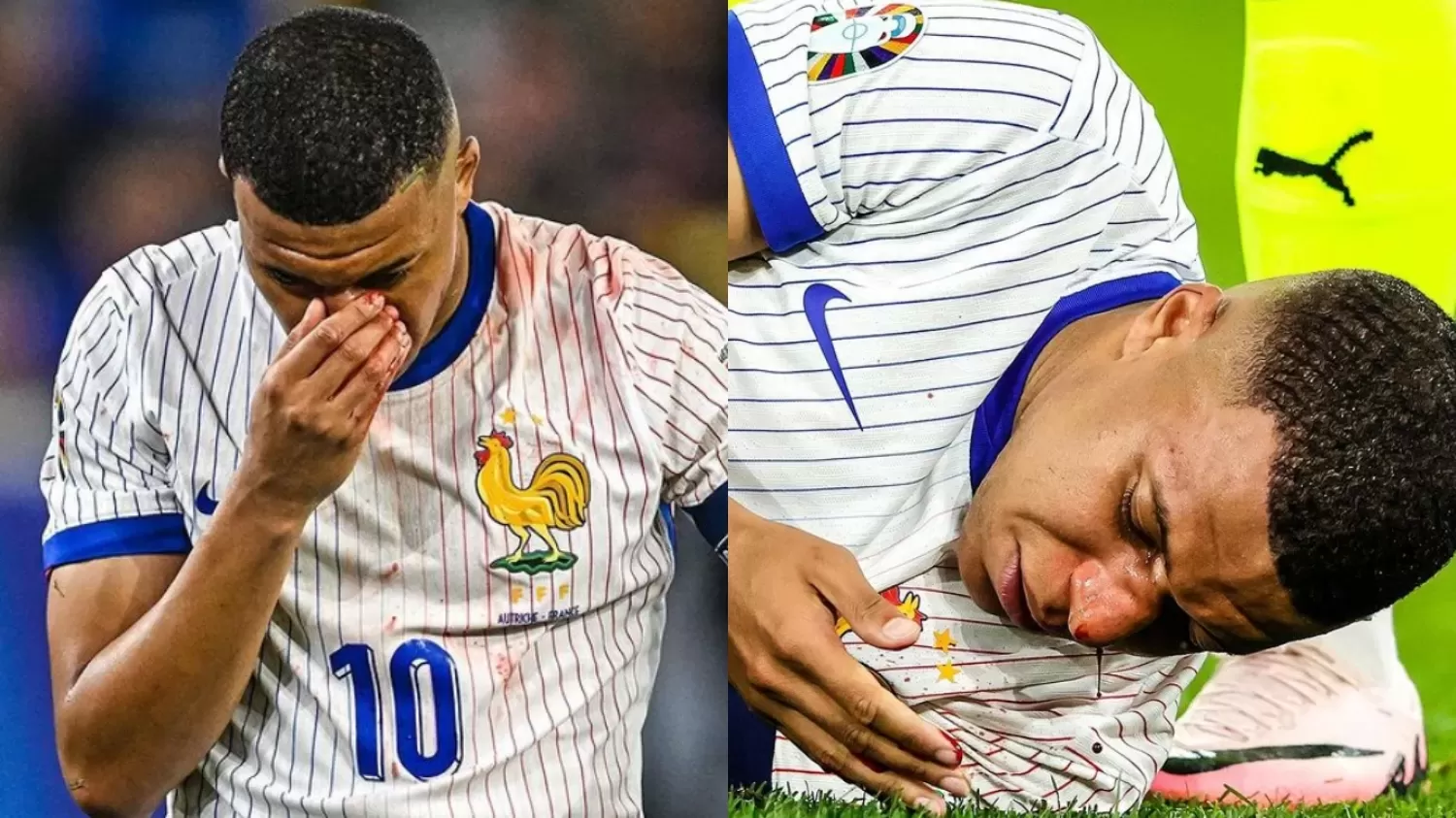 Foto Kejadian Mbappe Patah Tulang Hidung