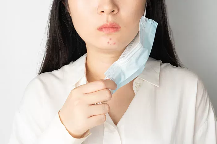 Penyebab Munculnya Jerawat di Dagu dan Cara Mengatasinya(Sumber:Pixabay/Pexels)