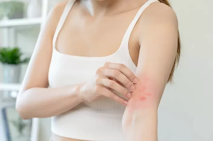 Jenis-jenis ruam kulit. (Pixabay/Brunos)