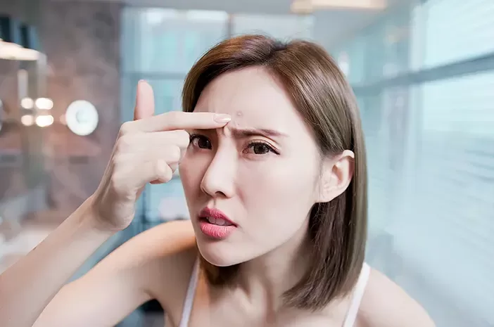 8 Cara menghilangkan bruntusan di jidat. (Sumber:Pixabay/Olivias)