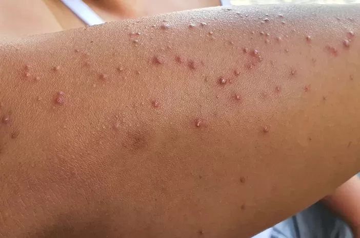 Muncul Jerawat di Tangan, Penyebab dan Cara Mengatasinya(Sumber:Pixabay/SummerR)