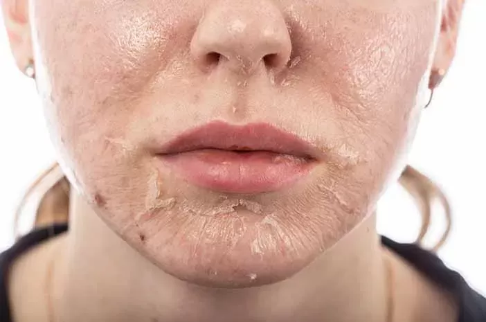 5 Manfaat chemical peeling untuk kulit berjerawat. (Sumber:Pixabay/Marth)