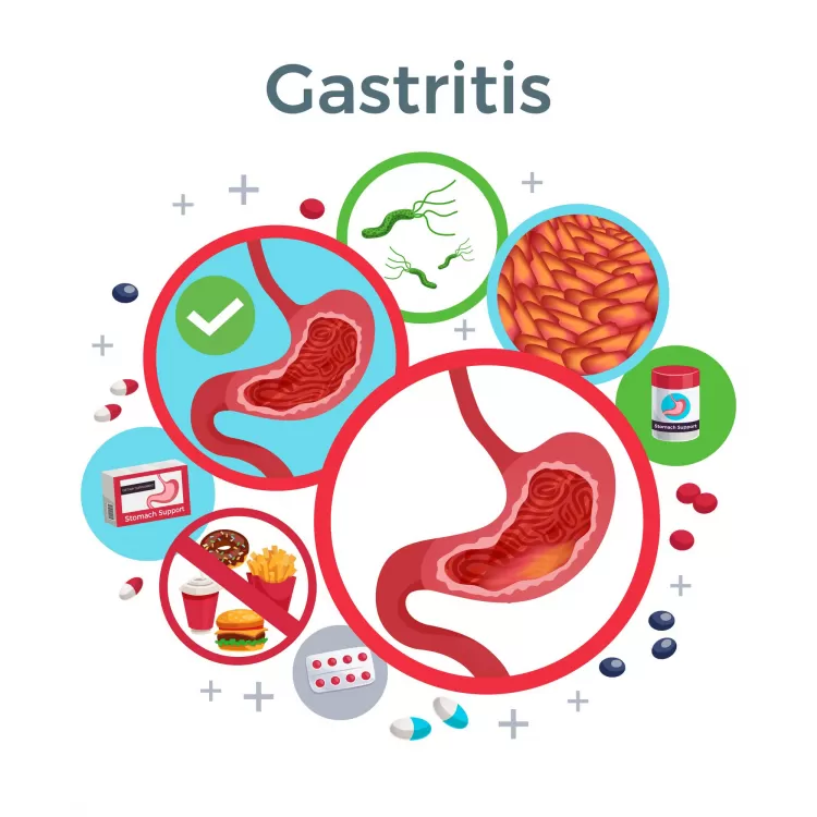 Kenali Gastritis Ini Penyebab Dan Cara Mencegahnya Akurat