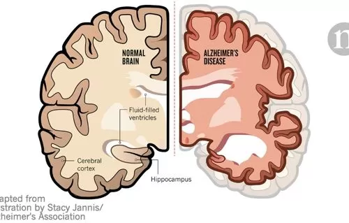 Makanan Mengandung Selenium Mampu Cegah Alzheimer
