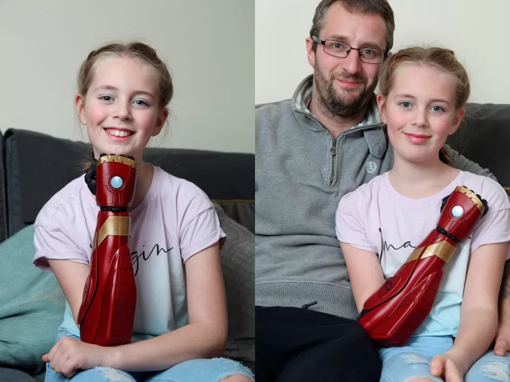 Hollie Lownds, gadis 11 tahun yang memiliki lengan bionik Iron Man. (mirror.co.uk)