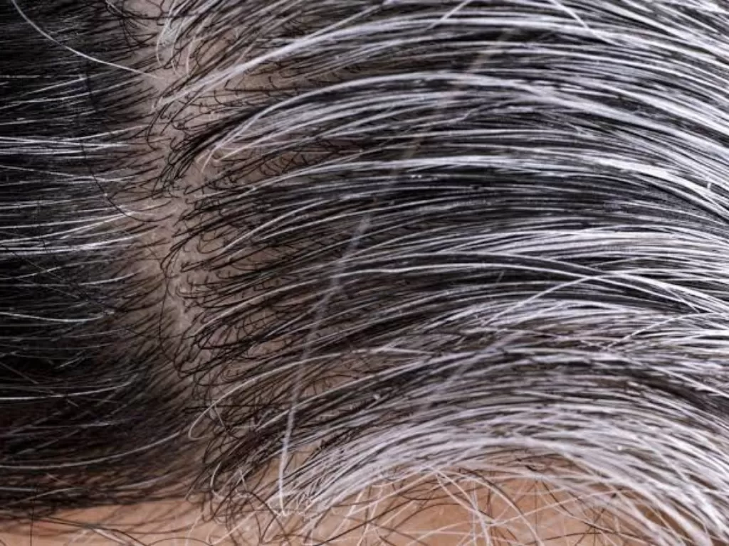 Ilustrasi rambut beruban. (Ilustrasi/medicalnewstoday.com)
