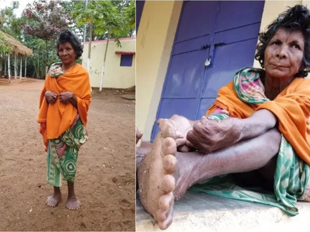 Kumari, wanita asal India yang memiliki jari banyak (SWNS/Metro)