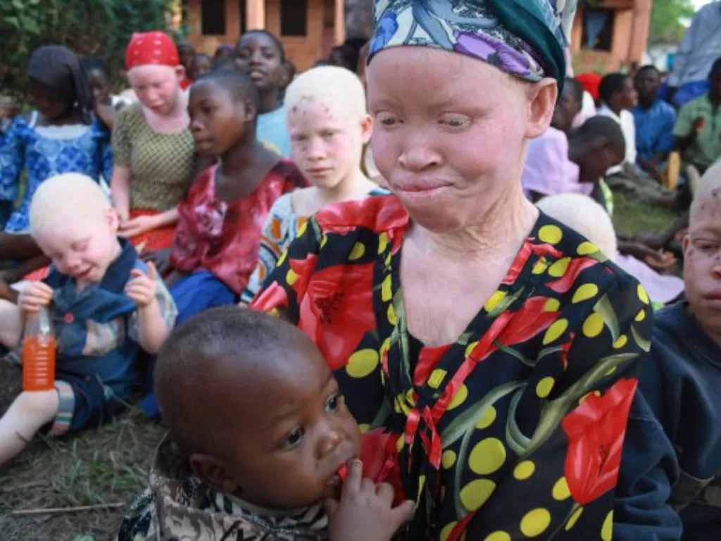 Orang-orang Albino di Tanzania. (Flickr/IFRC)