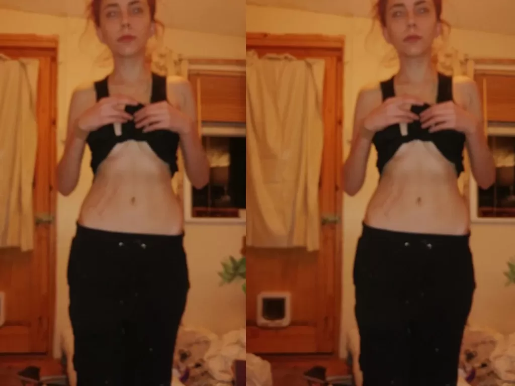 Gemma Harenburg mengidap anoreksia (SWNS)