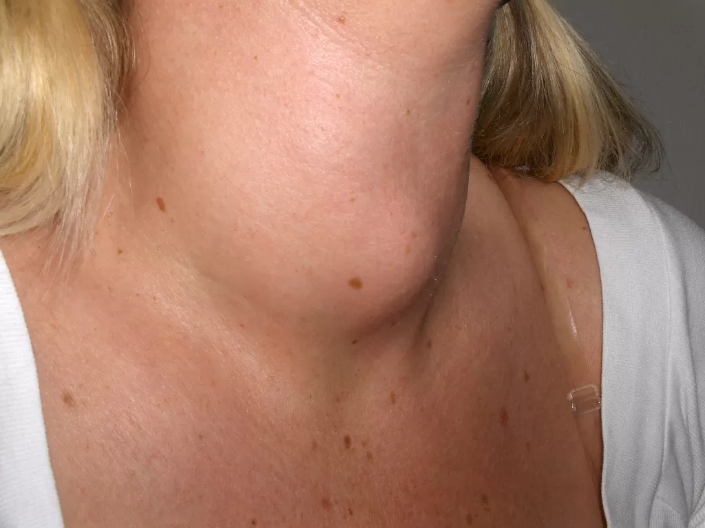 Ilustrasi penyakit gondok menyebabkan bengkak di leher (Wikipedia)