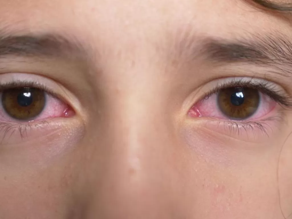 Mata merah tanda virus corona (Istimewa)