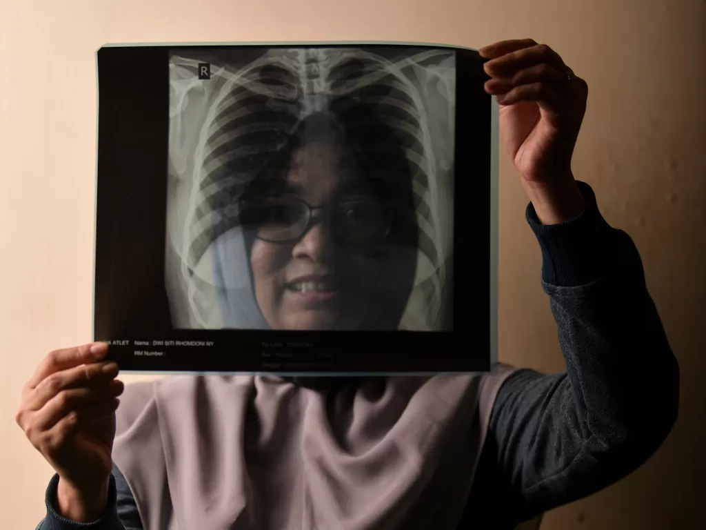 Dwieky Siti Rhomdoni (37) menunjukkan hasil rontgen paru-paru miliknya di Jakarta, 14 April 2020. (ANTARA FOTO/Nova Wahyudi)