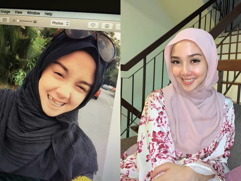 Kiri: penampilan Nurin saat masih ompong / Kanan: penampilan Nurin setelah giginya sudah berhasil diperbaiki. (Instagram/@nurinafiqaaah)