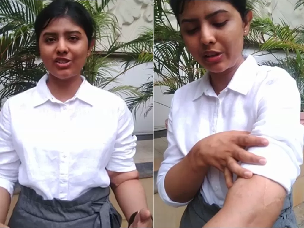 Shreya Siddanagowder, gadis India yang lakukan transplantasi tangan. (Facebook/MOHAN Foundation)
