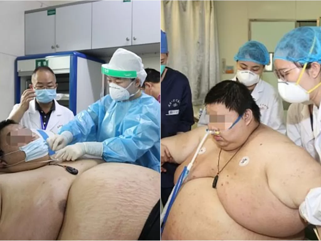 Zhou, pria asal Tiongkok yang alami kenaikan berat badan hingga 101 kilogram. (Zhongnan Hospital of Wuhan University)