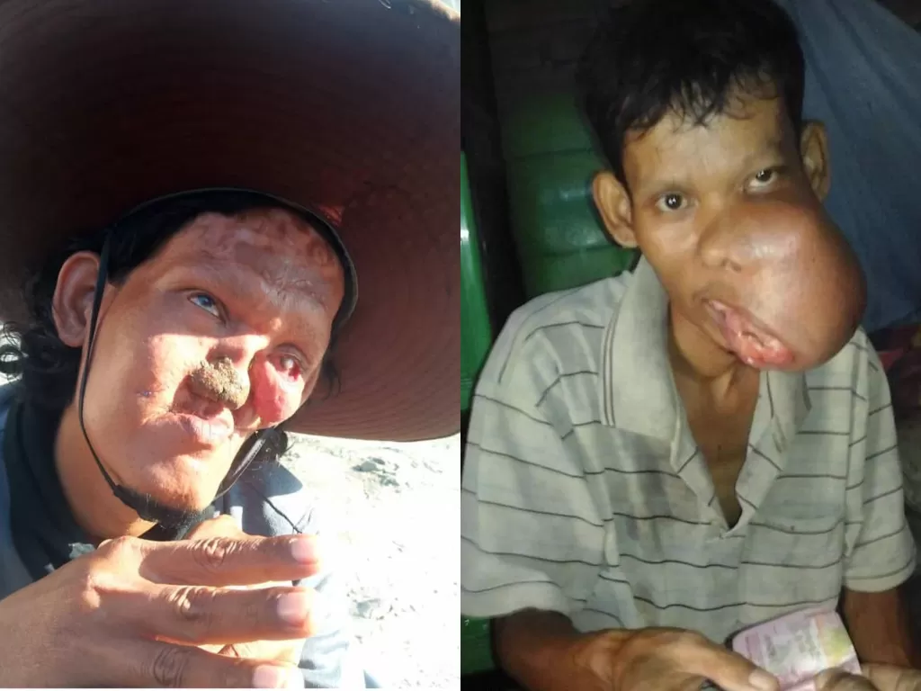 Safri (35), pria tiga anak menderita tumor ganas sejak SMP dan sudah lima kali operasi. (Foto: Istimewa)