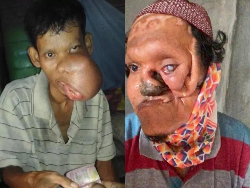 Safri (35), pria tiga anak menderita tumor ganas sejak SMP dan sudah lima kali operasi. (Foto: Istimewa)