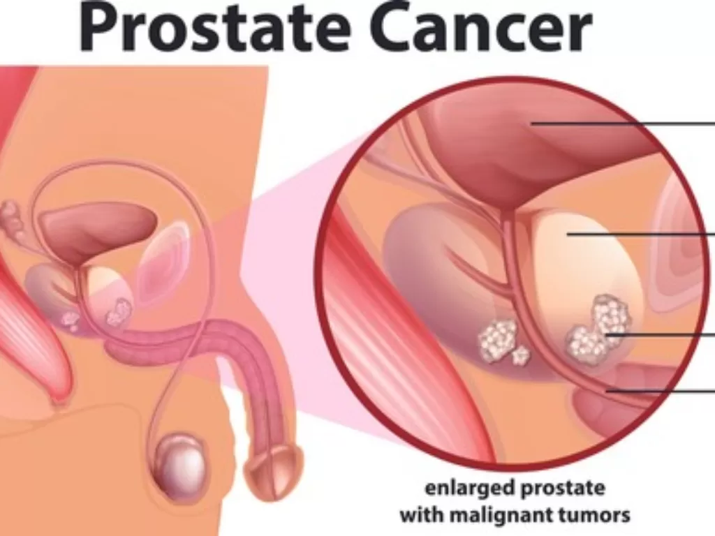 Ilustrasi kanker prostat (jamaicamoves.com)
