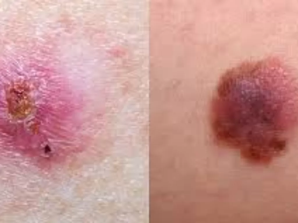 Ilustrasi kanker kulit (photo/Prevention.com)