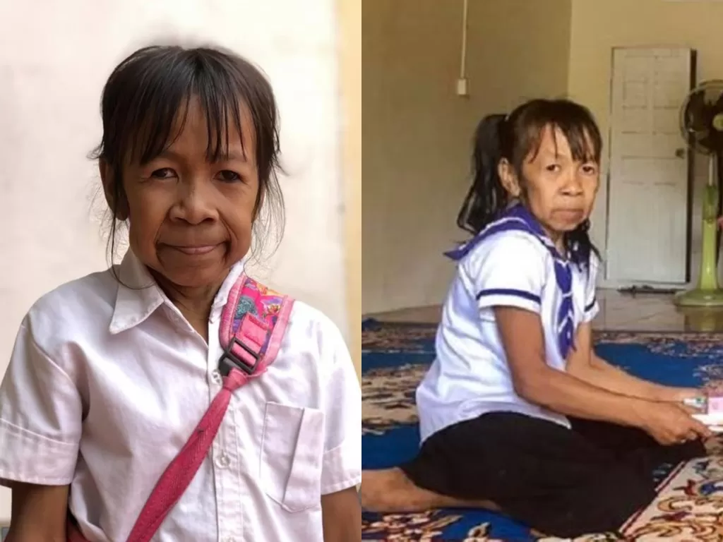 Bo Rakching, gadis berusia 11 tahun asal Kamboja yang  menderita Lipodystrophy. (Omgnews.cc/Dongsen News)
