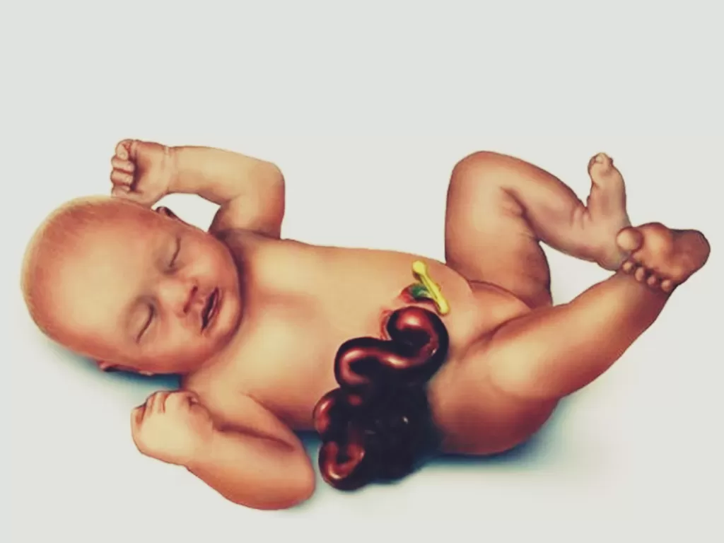 Ilustrasi bayi dengan Gastroschisis. (fbhealthremedies.com)