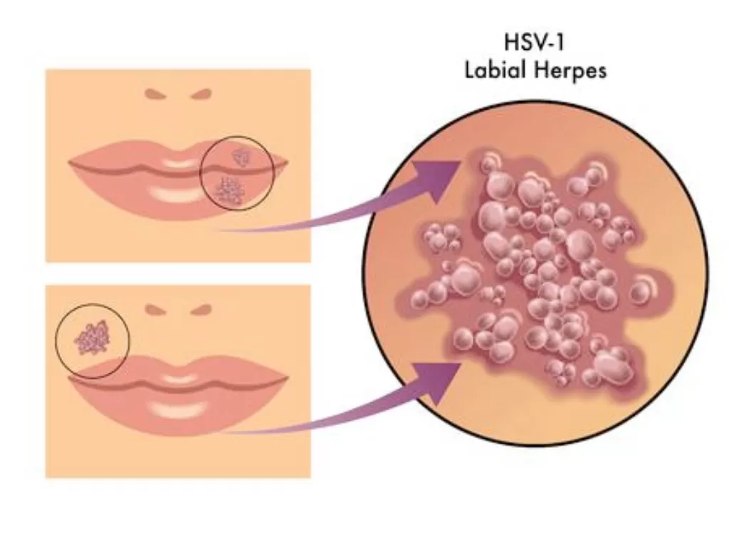 Ilustrasi herpes (123rf)