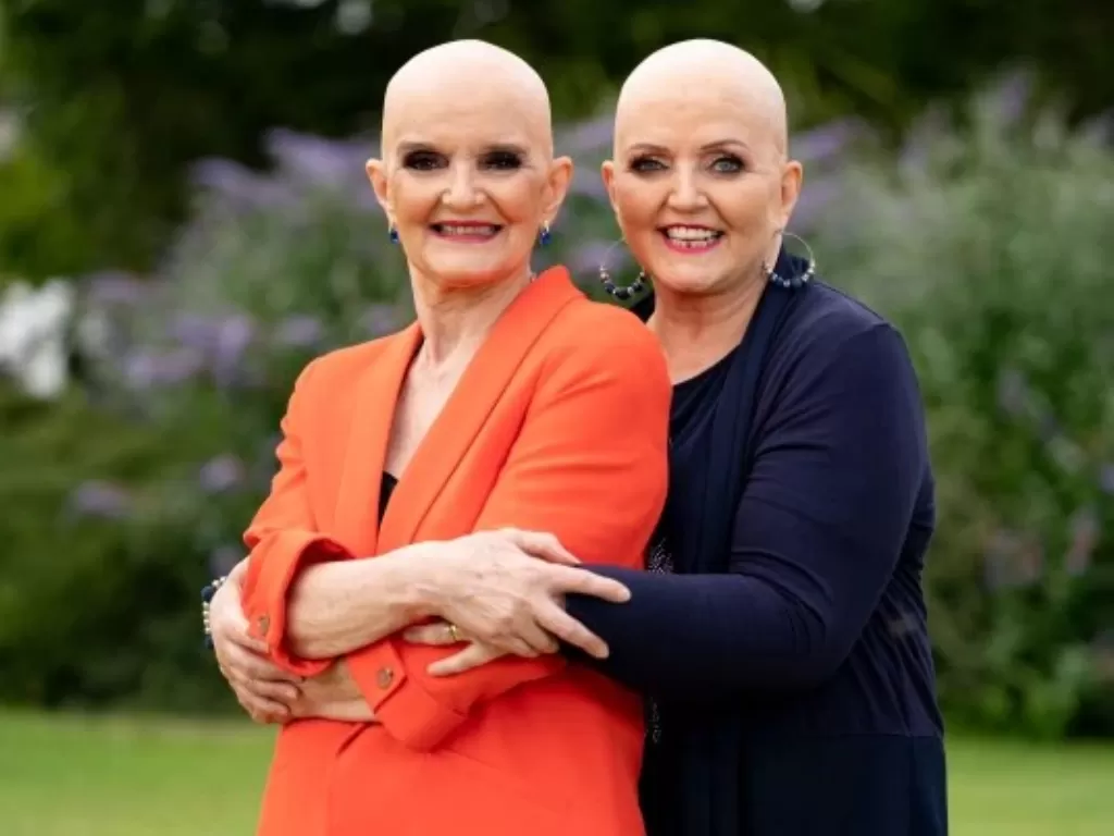 Linda Nolan dan Anne Nolan, personel The Nolans yang terserang kanker hingga botak. (Foto: Istimewa)