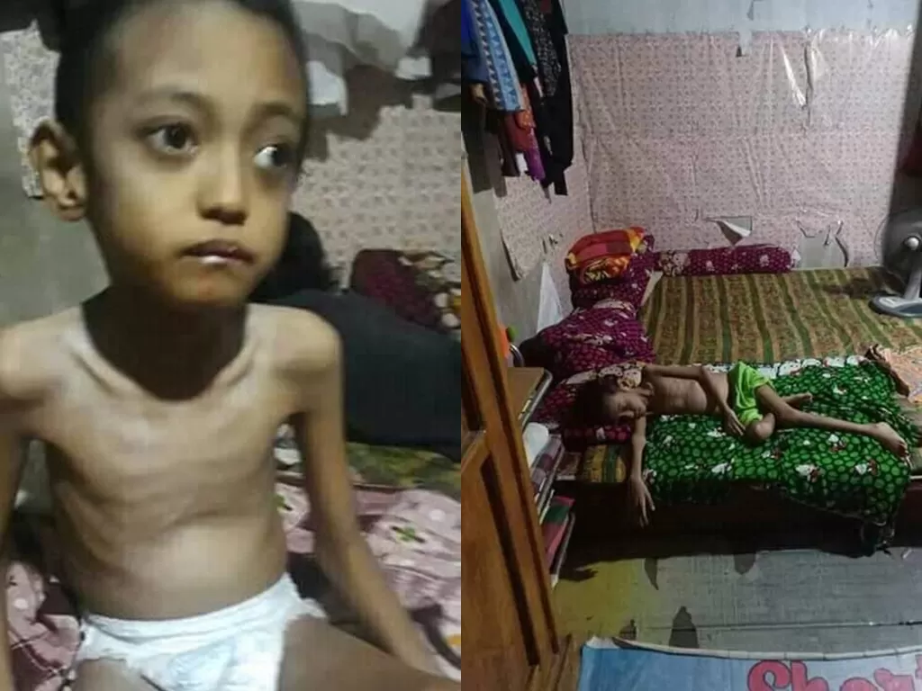 Kondisi bocah 13 tahun penderita gizi buruk di Makassar, Sulawesi Selatan.