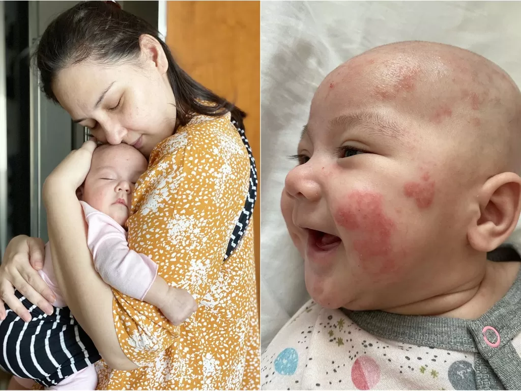 Kiri: Mona Ratuliu dan anaknya. Kanan: Anak Mona Ratuliu mengalami dermatitis atopik. (Instagram/@monaratuliu)