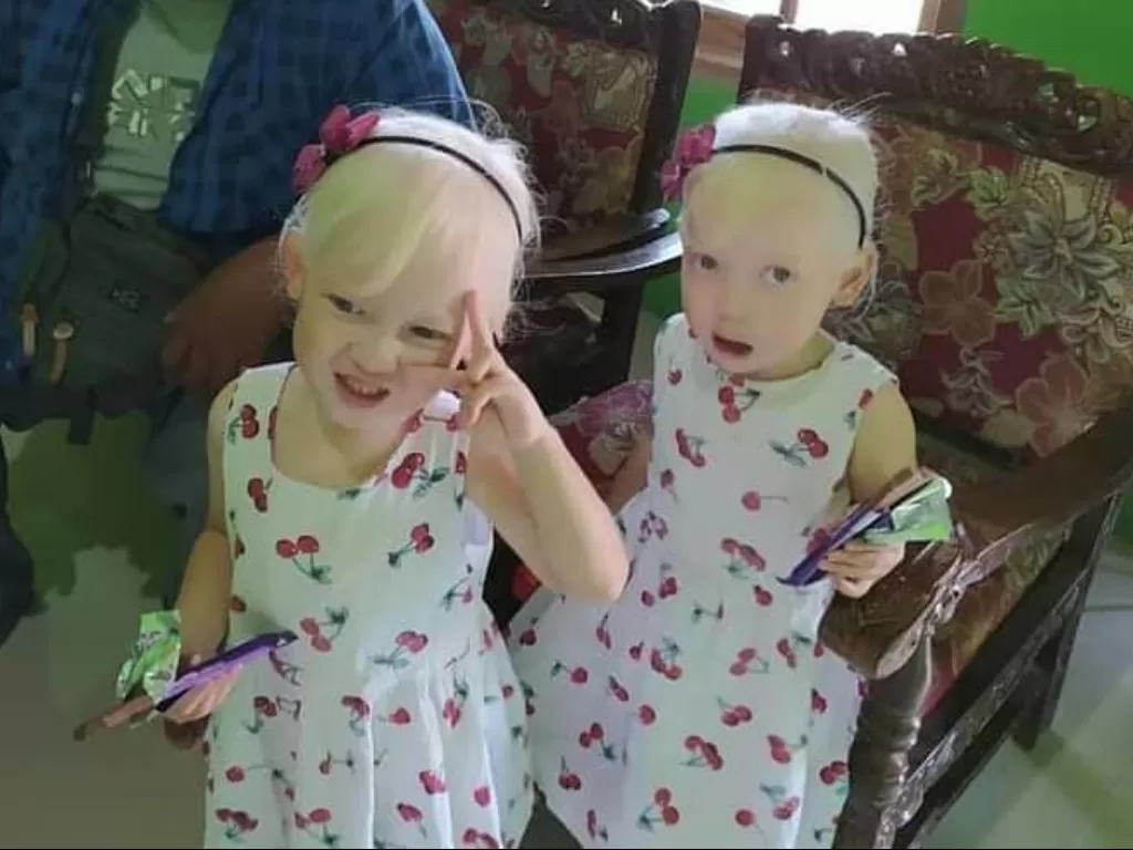 Nadira Nur Ainiyah dan Nadia Nur Azahra, anak kembar albino di Wonogiri. (Istimewa)
