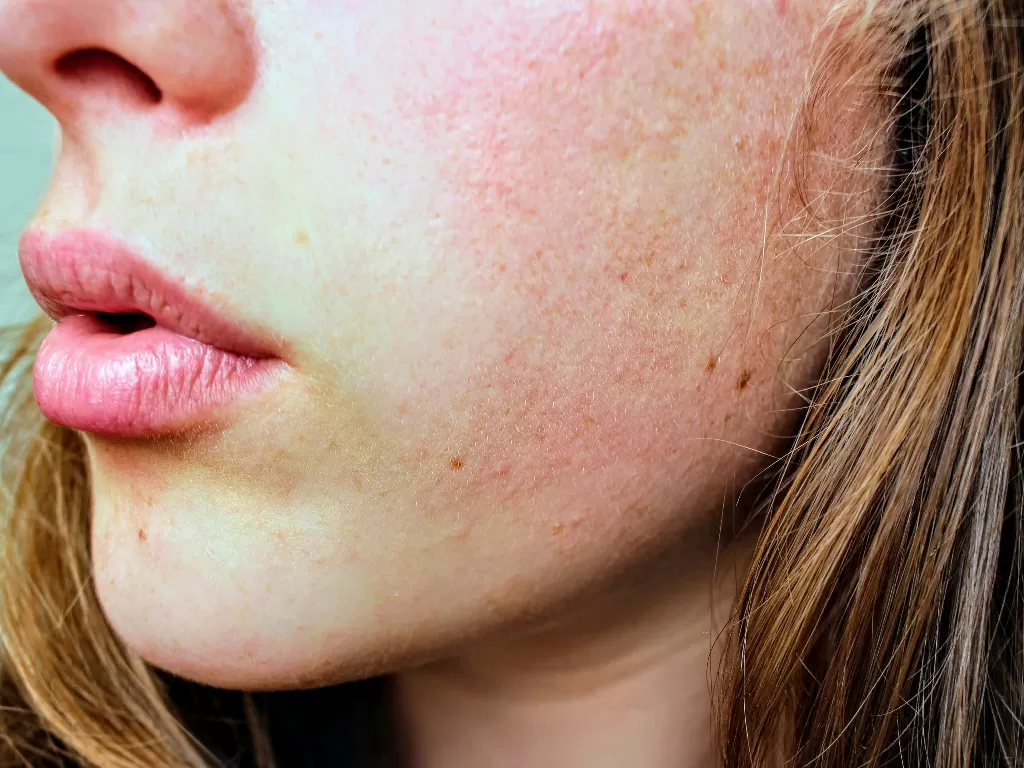 Ilustrasi alergi kulit (Pexels/Jenna Hamra)