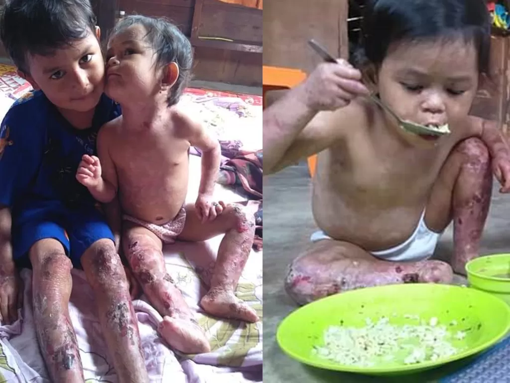 Abang dan adiknya yang menderita penyakit aneh kini butuh bantuan. (Facebook Naiysa Ray)