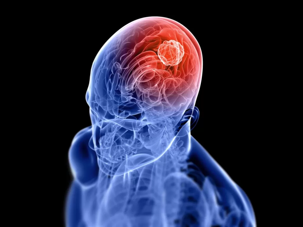 Tumor otak (matherhospital.org)