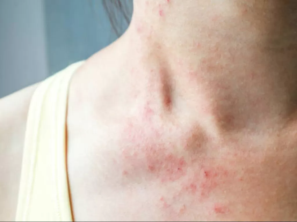 Ilustrasi alergi kulit (vix.com)