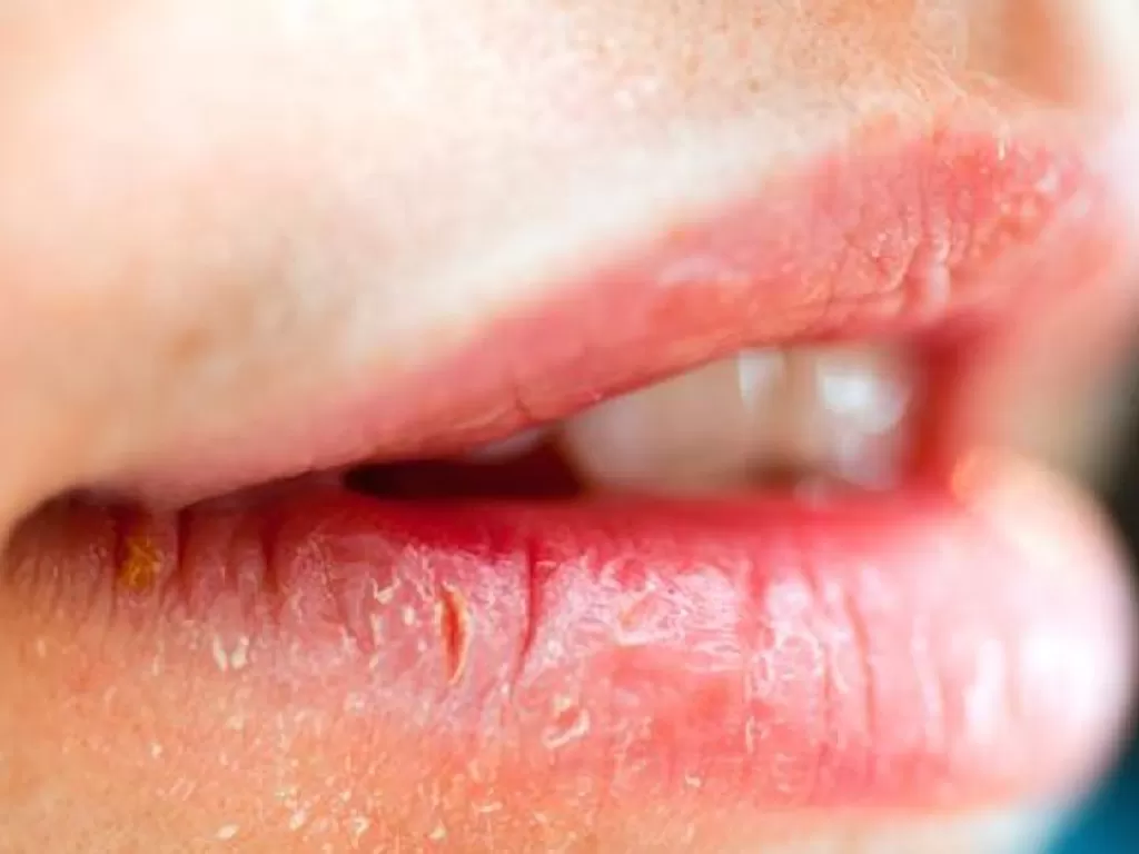 Ilustrasi bibir kering pecah pecah (oklahoman.com)