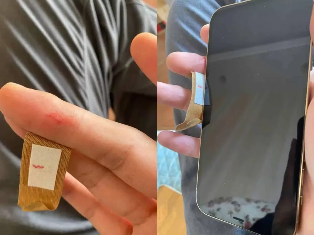 Pengguna iPhone 12 yang mengalami luka akibat smartphonenya (photo/MyDrivers via. GizChina)