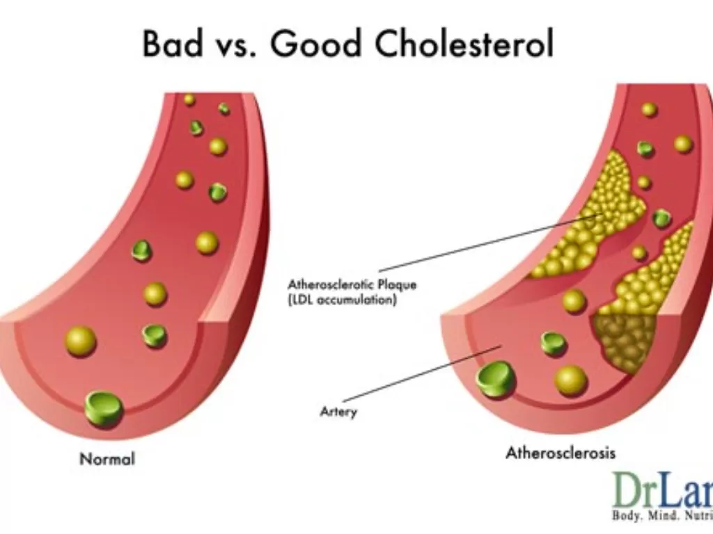 Ilustrasi kolesterol (drlamcoaching)