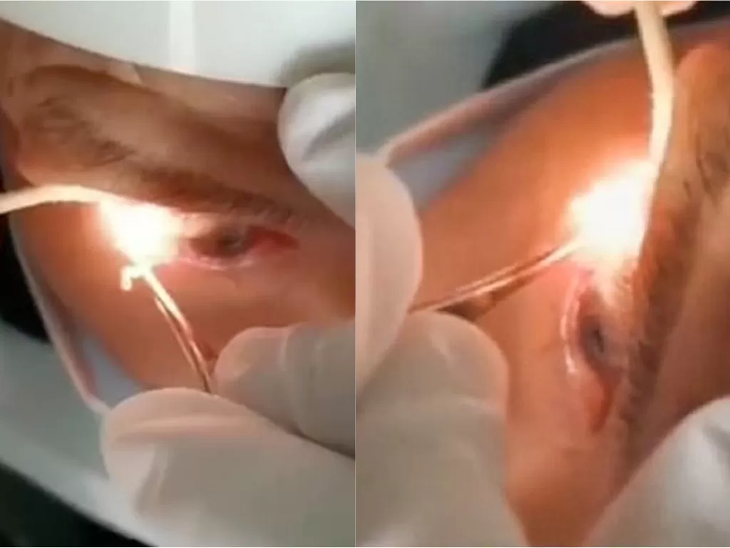 Operasi mengeluarkan 20 cacing dari mata pria (Suzhou Daily News/Weibo)