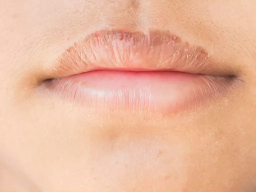 Ilustrasi bibir pecah-pecah (medicalnewstoday.com)
