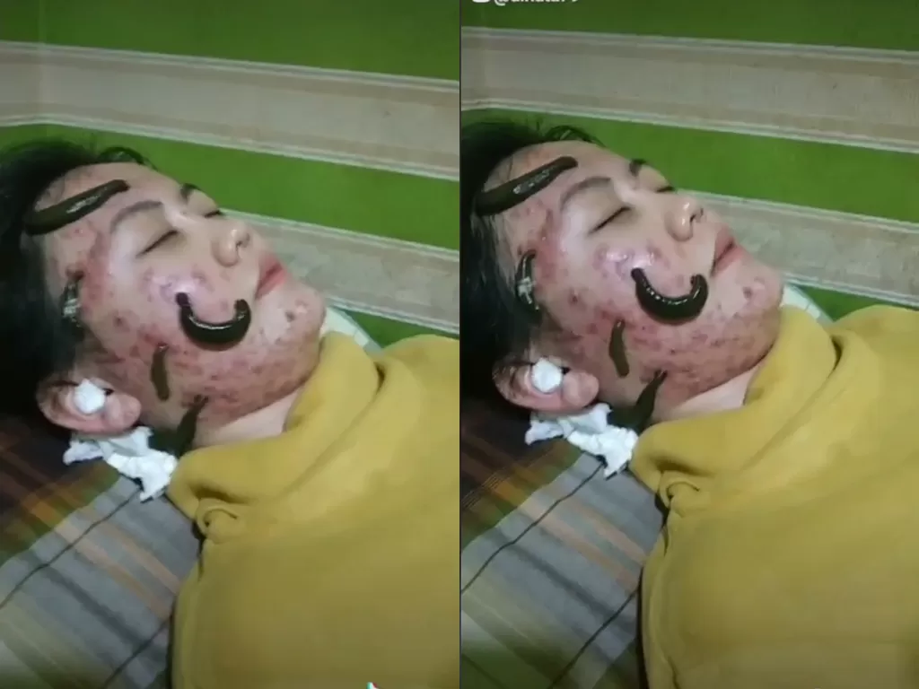Cuplikan video wanita yang obati wajahnya yang berjerawat. (photo/TikTok/@dinata79)