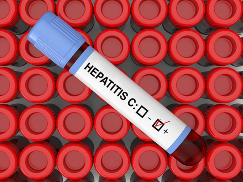 Ilustrasi hepatitis C (medpagetoday)