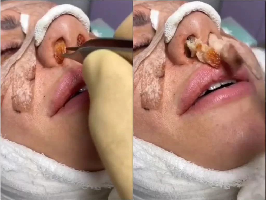 Cuplikan video proses setelah operasi sinus. (photo/Instagram/@ dr. Abramian)