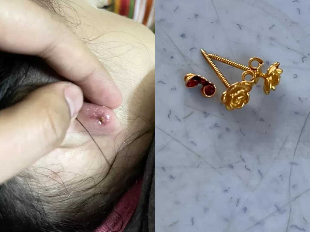 Bocah ini mengalami luka setelah dipakaikan anting-anting. (Photo/Facebook/Eyra Shira)