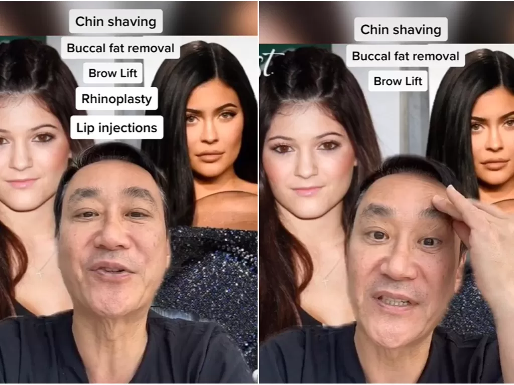 Perbedaan wajah Kylie Jenner sebelum dan sesudah oplas (TikTok/@drlee90210)