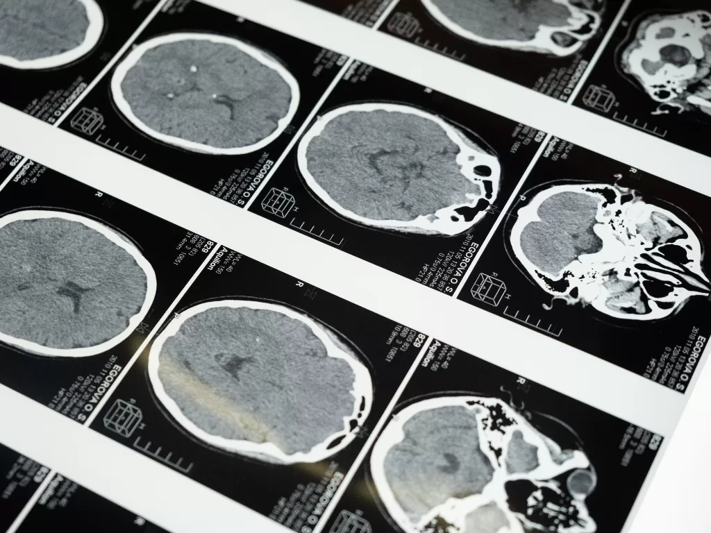 Ilustrasi hasil CT-Scan otak. (photo/Ilustrasi/Pexels/cottonbro)
