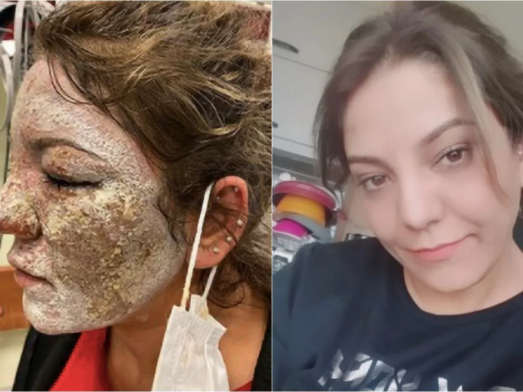 Perawatan gagal wajah wanita ini justru terbakar (Newsflash)