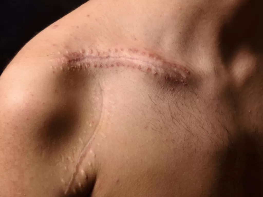 Ilustrasi cara menghilangkan bekas luka (photo/freepik/josepcurto)
